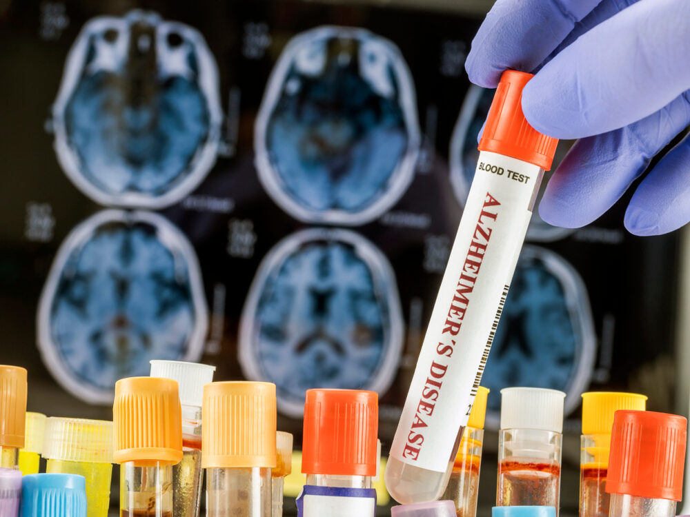 Organoidi cerebrali e ricerca sull'Alzheimer